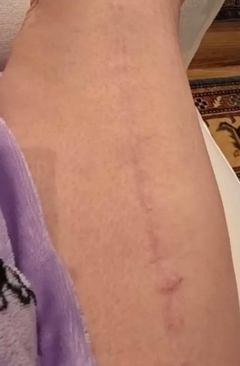 Scar remodel two, after view, after view